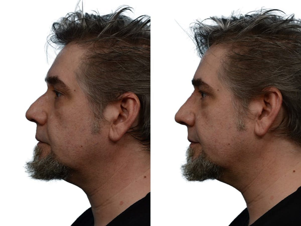 Non-Surgical Rhinoplasty Before & After Gallery - Patient 386470 - Image 1