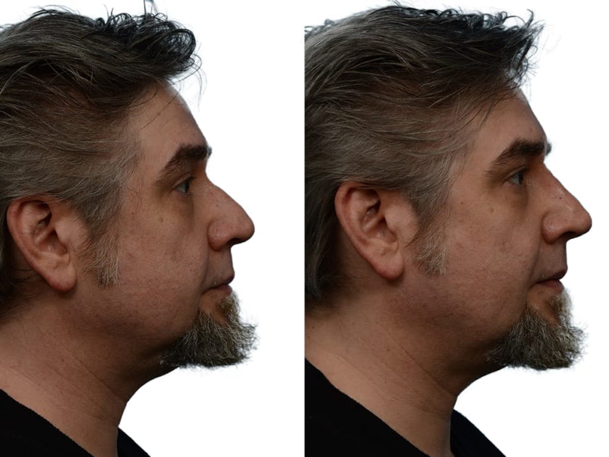 Non-Surgical Rhinoplasty Before & After Gallery - Patient 386470 - Image 3
