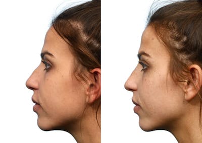 Non-Surgical Rhinoplasty Before & After Gallery - Patient 298318 - Image 1