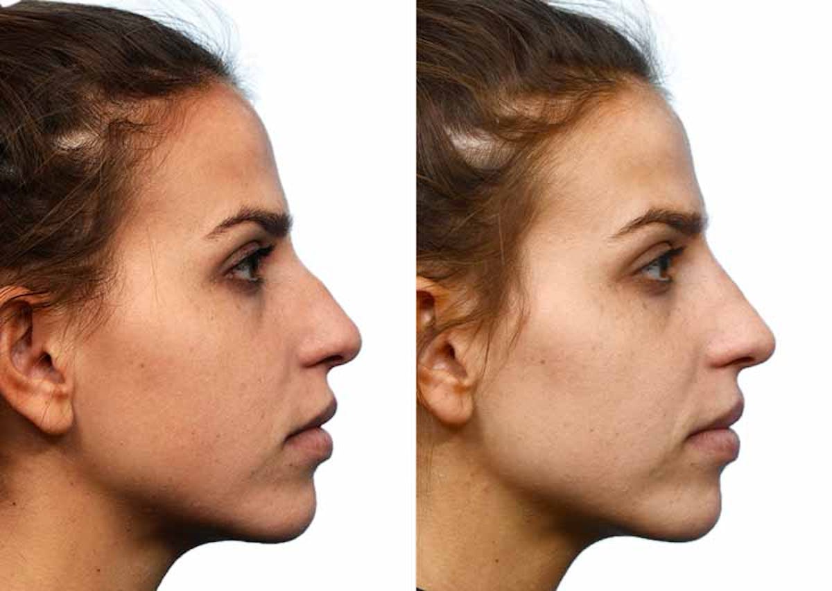 Non-Surgical Rhinoplasty Before & After Gallery - Patient 298318 - Image 2