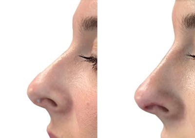 Non-Surgical Rhinoplasty Before & After Gallery - Patient 391111 - Image 1