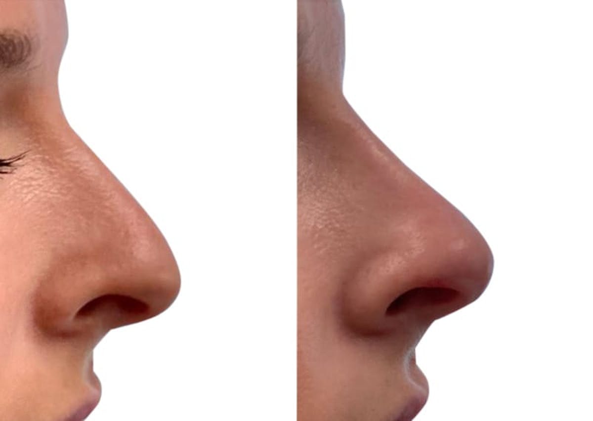 Non-Surgical Rhinoplasty Before & After Gallery - Patient 391111 - Image 2