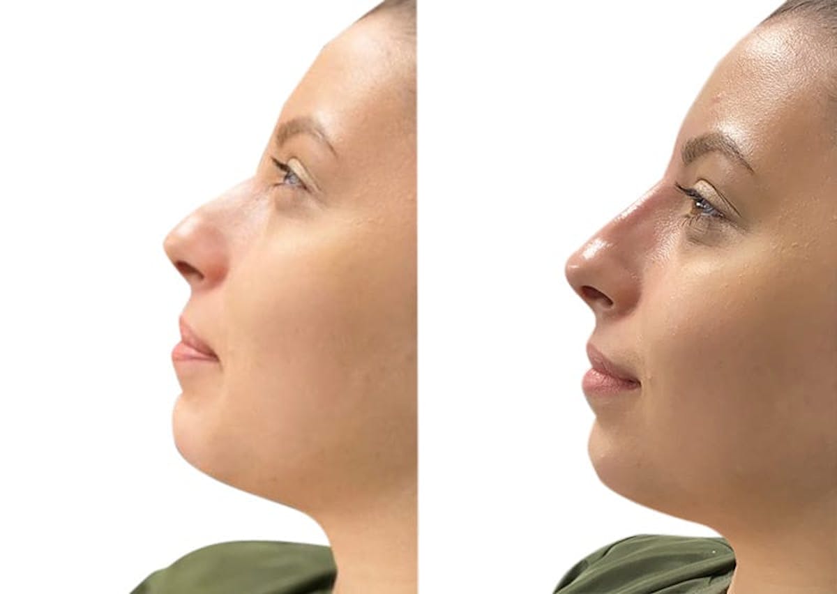 Non-Surgical Rhinoplasty Before & After Gallery - Patient 359779 - Image 1