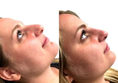 Non-Surgical Rhinoplasty Before & After Gallery - Patient 299570 - Image 1