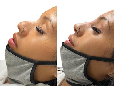 Non-Surgical Rhinoplasty Before & After Gallery - Patient 118391 - Image 1