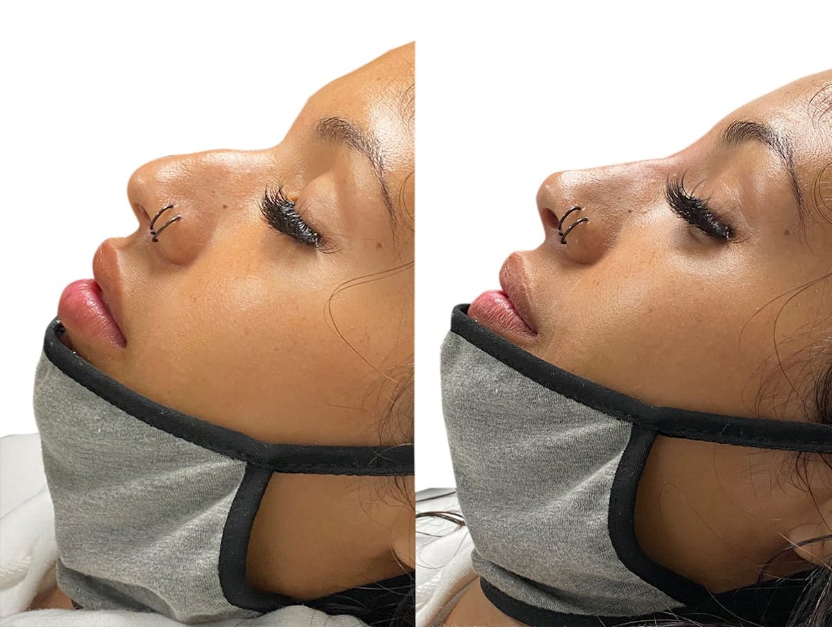 Non-Surgical Rhinoplasty Before & After Gallery - Patient 118391 - Image 1