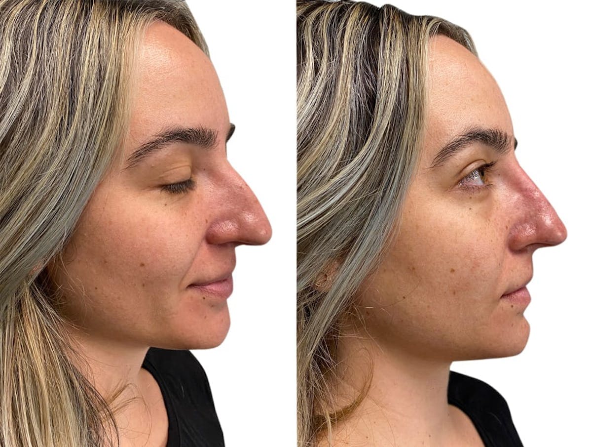 Non-Surgical Rhinoplasty Before & After Gallery - Patient 104159 - Image 2