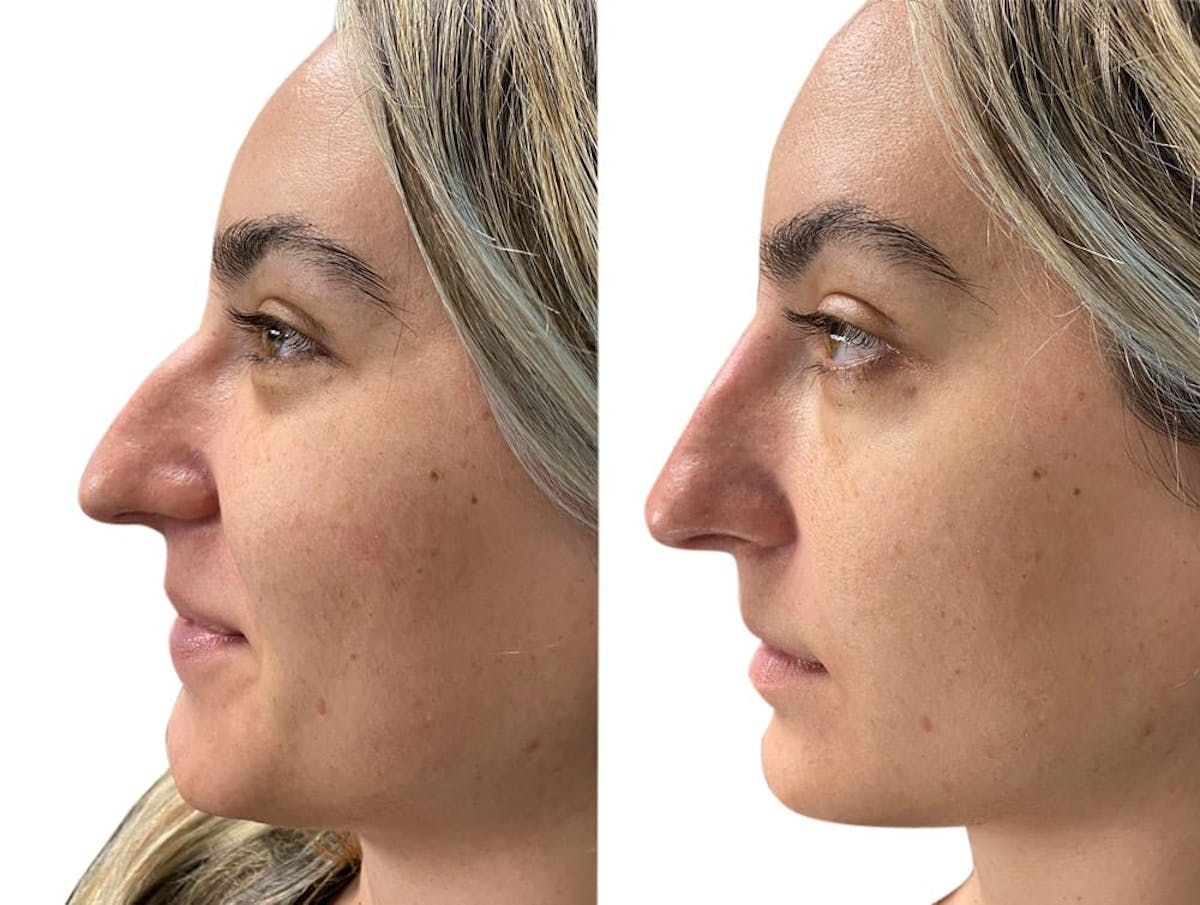Non-Surgical Rhinoplasty Before & After Gallery - Patient 104159 - Image 1
