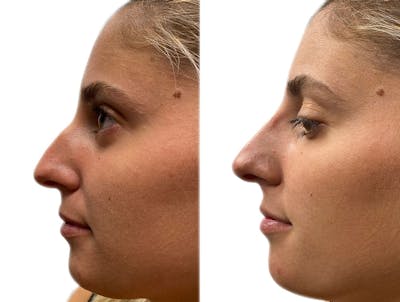 Non-Surgical Rhinoplasty Before & After Gallery - Patient 228271 - Image 1