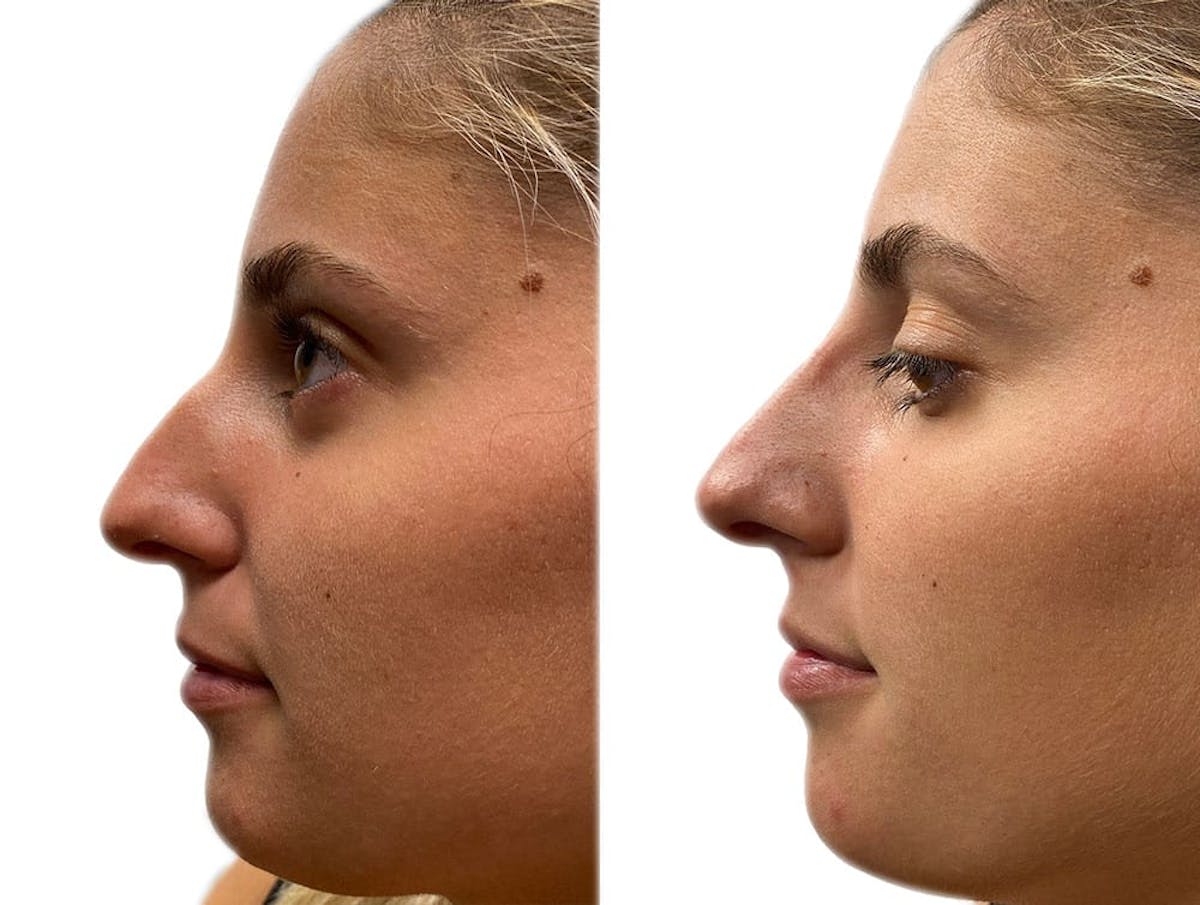 Non-Surgical Rhinoplasty Before & After Gallery - Patient 228271 - Image 1
