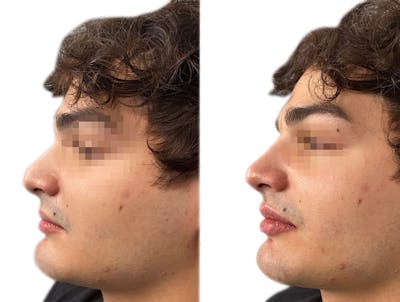 Non-Surgical Rhinoplasty Before & After Gallery - Patient 274791 - Image 1