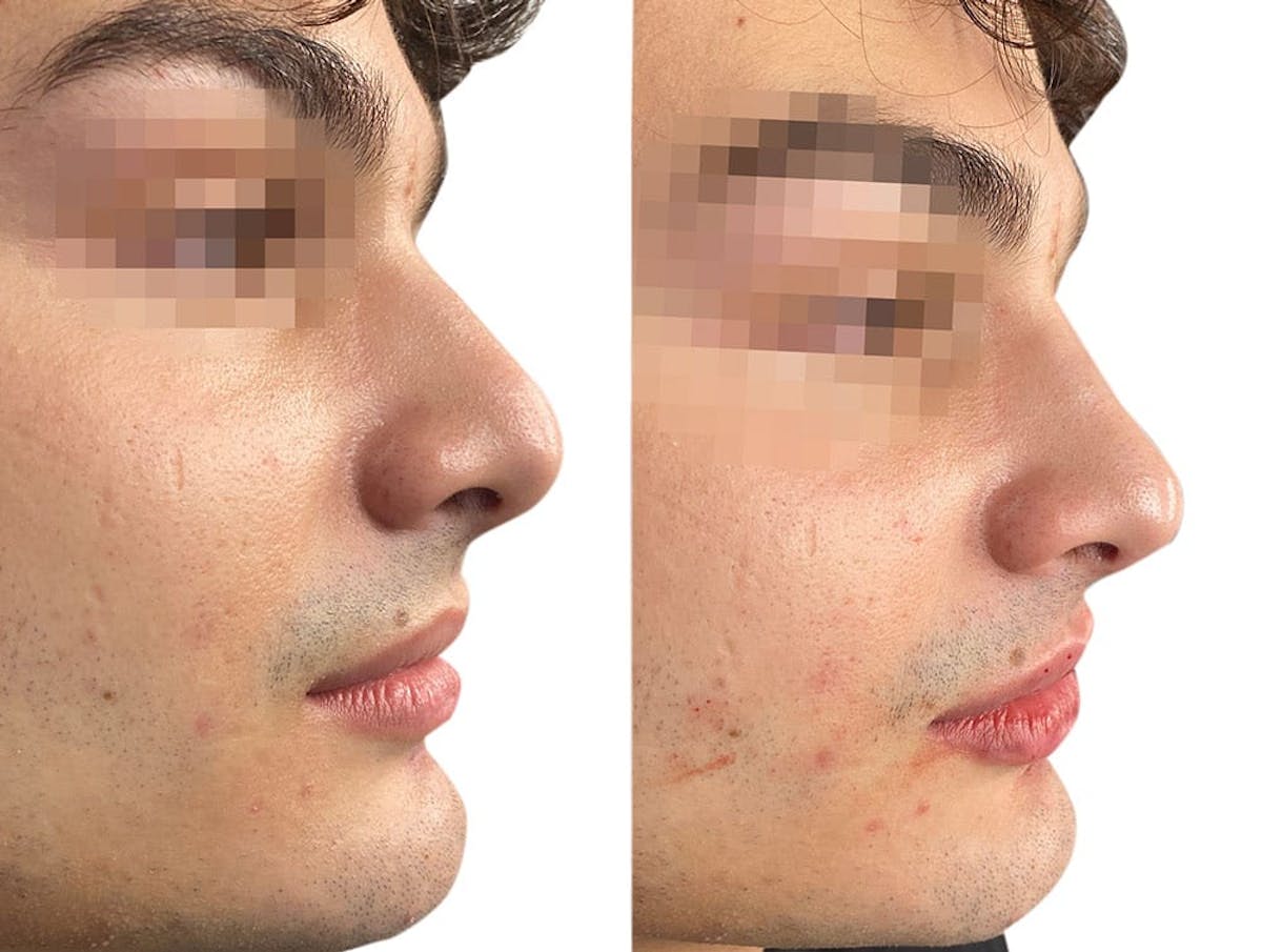 Non-Surgical Rhinoplasty Before & After Gallery - Patient 274791 - Image 2
