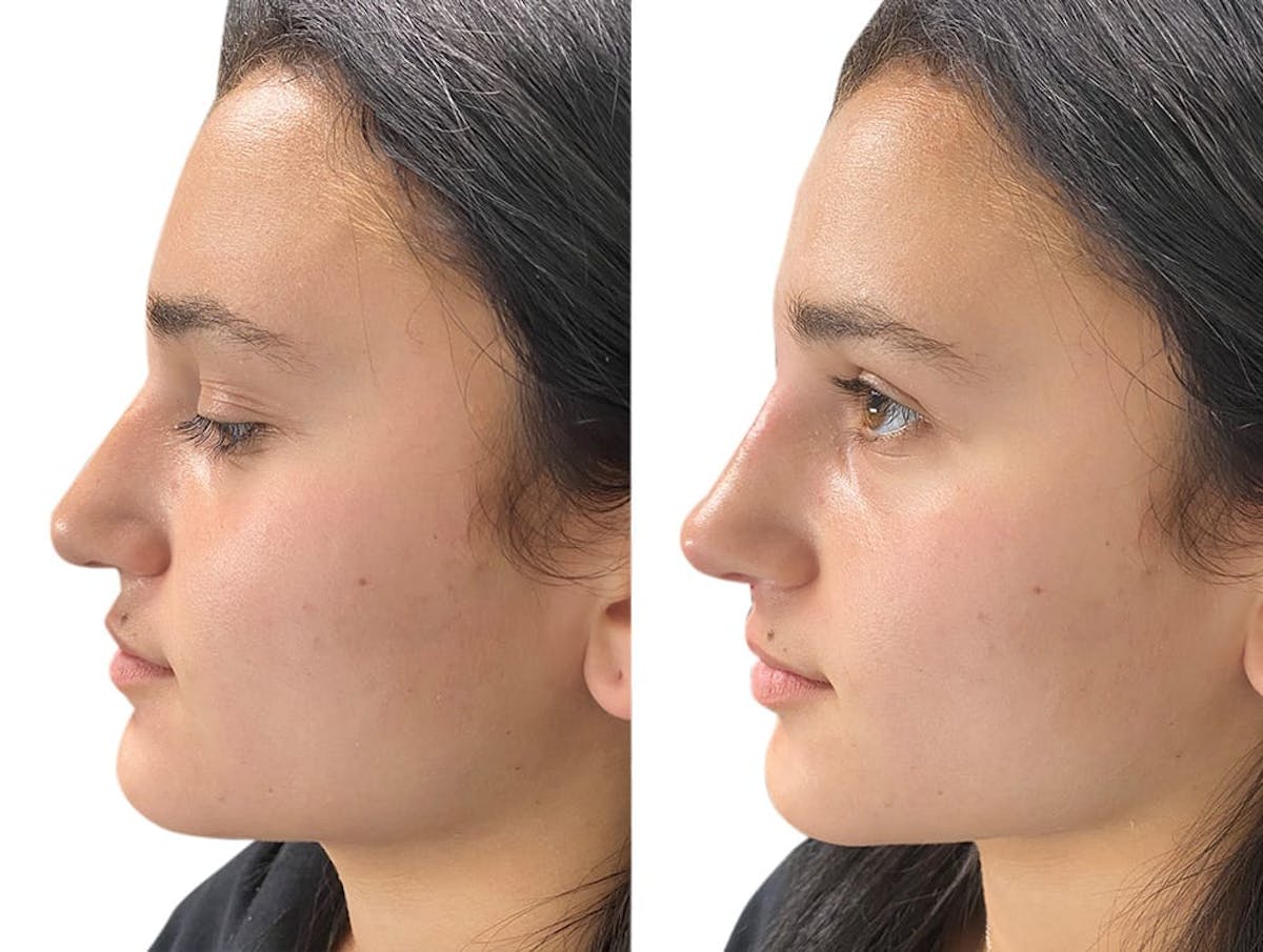 Non-Surgical Rhinoplasty Before & After Gallery - Patient 371174 - Image 1