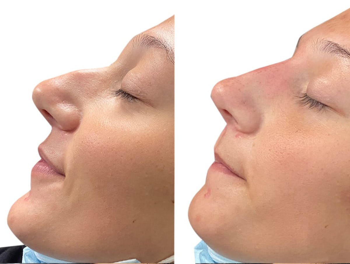 Non-Surgical Rhinoplasty Before & After Gallery - Patient 124632 - Image 1