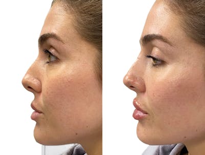 Non-Surgical Rhinoplasty Before & After Gallery - Patient 322962 - Image 1