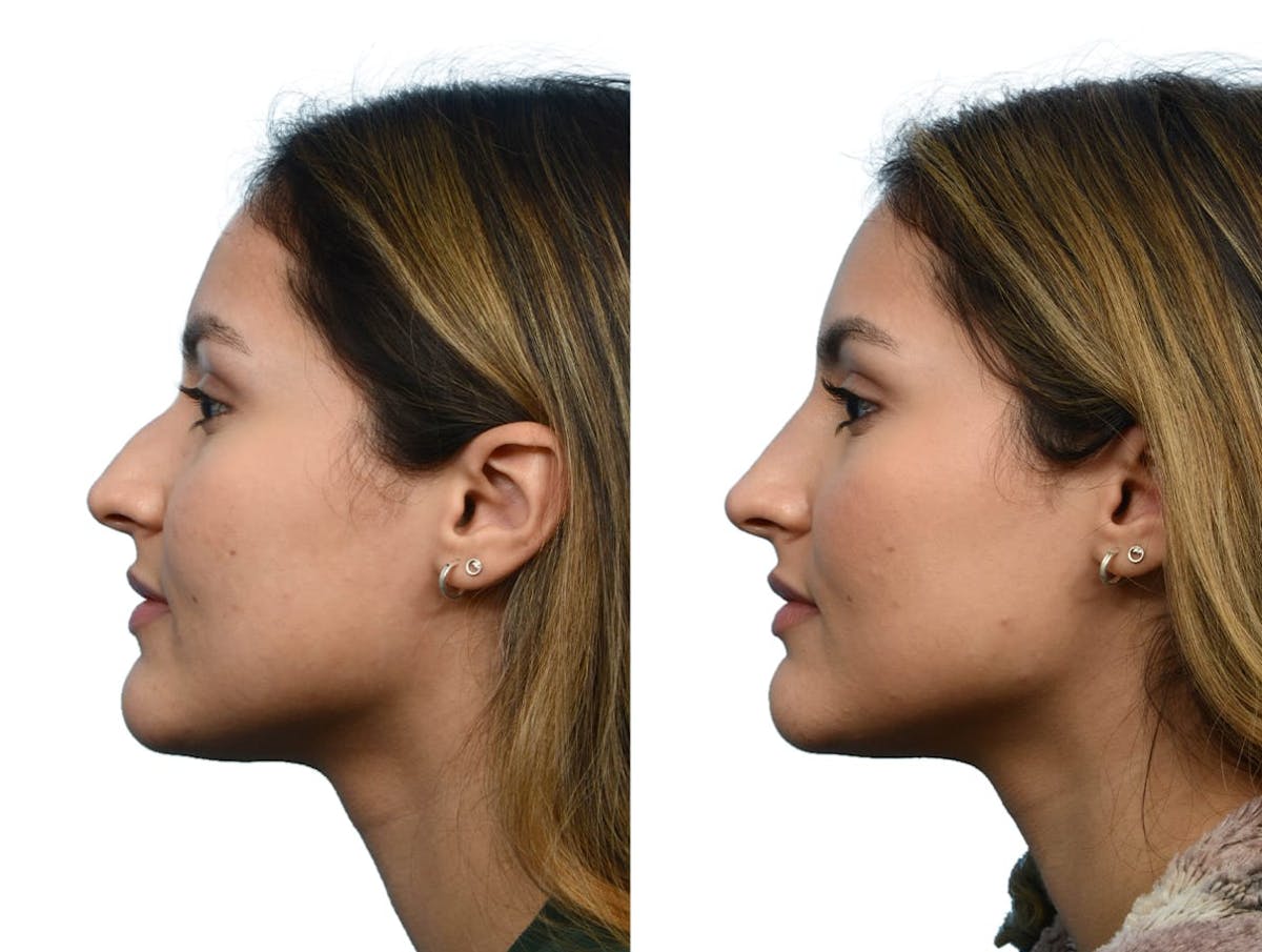 Non-Surgical Rhinoplasty Before & After Gallery - Patient 255551 - Image 1