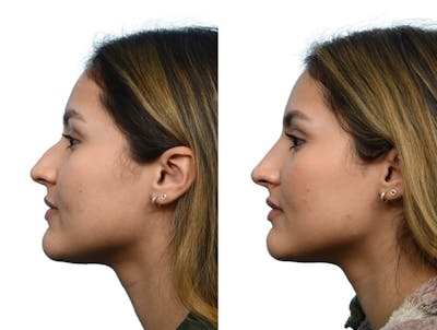 Non-Surgical Rhinoplasty Before & After Gallery - Patient 255551 - Image 1