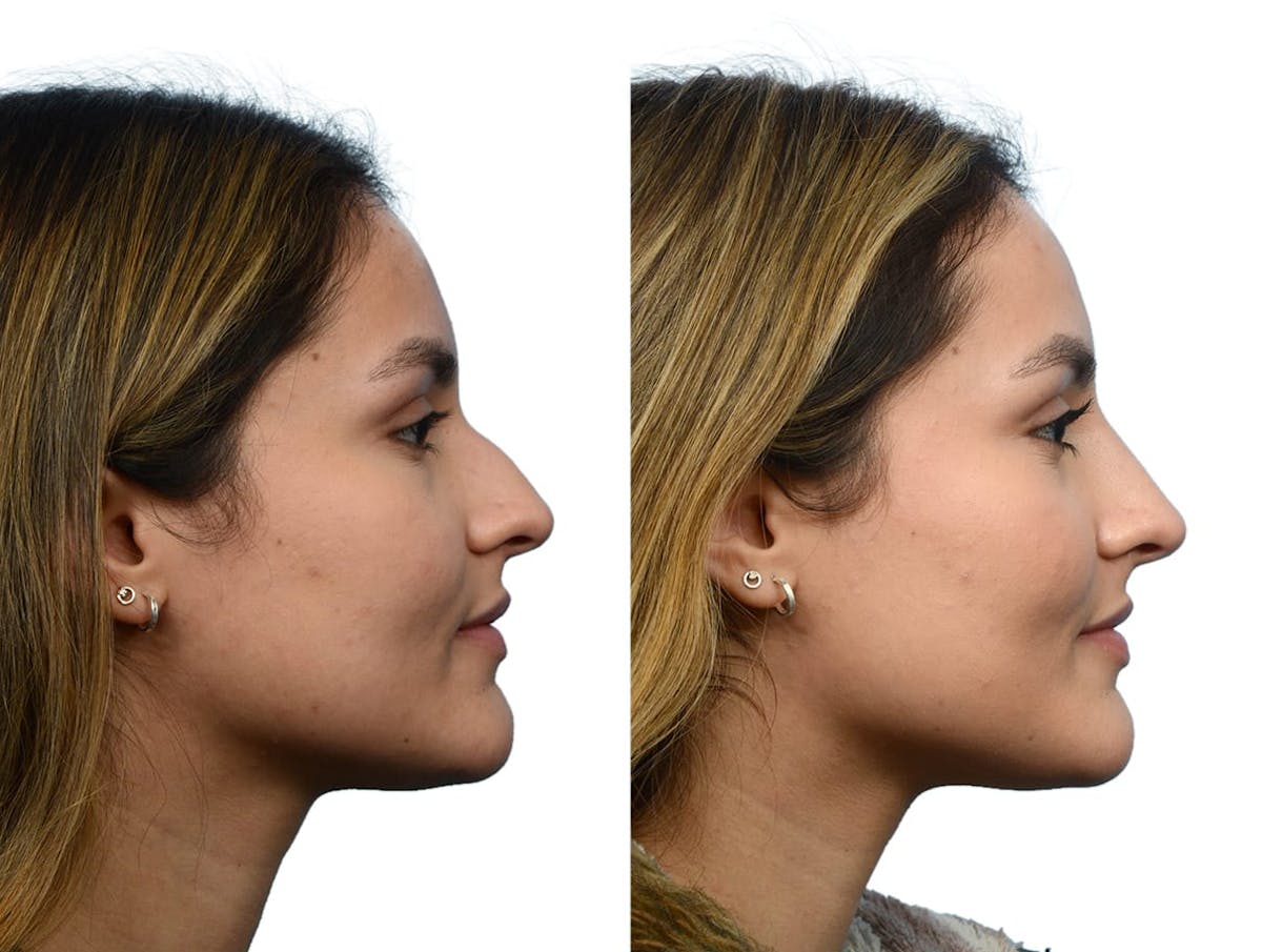 Non-Surgical Rhinoplasty Before & After Gallery - Patient 255551 - Image 2