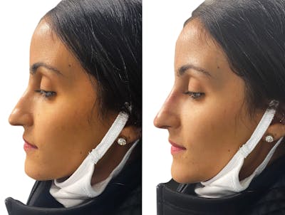 Non-Surgical Rhinoplasty Before & After Gallery - Patient 131897 - Image 1