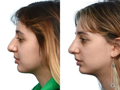 Non-Surgical Rhinoplasty Before & After Gallery - Patient 354630 - Image 1
