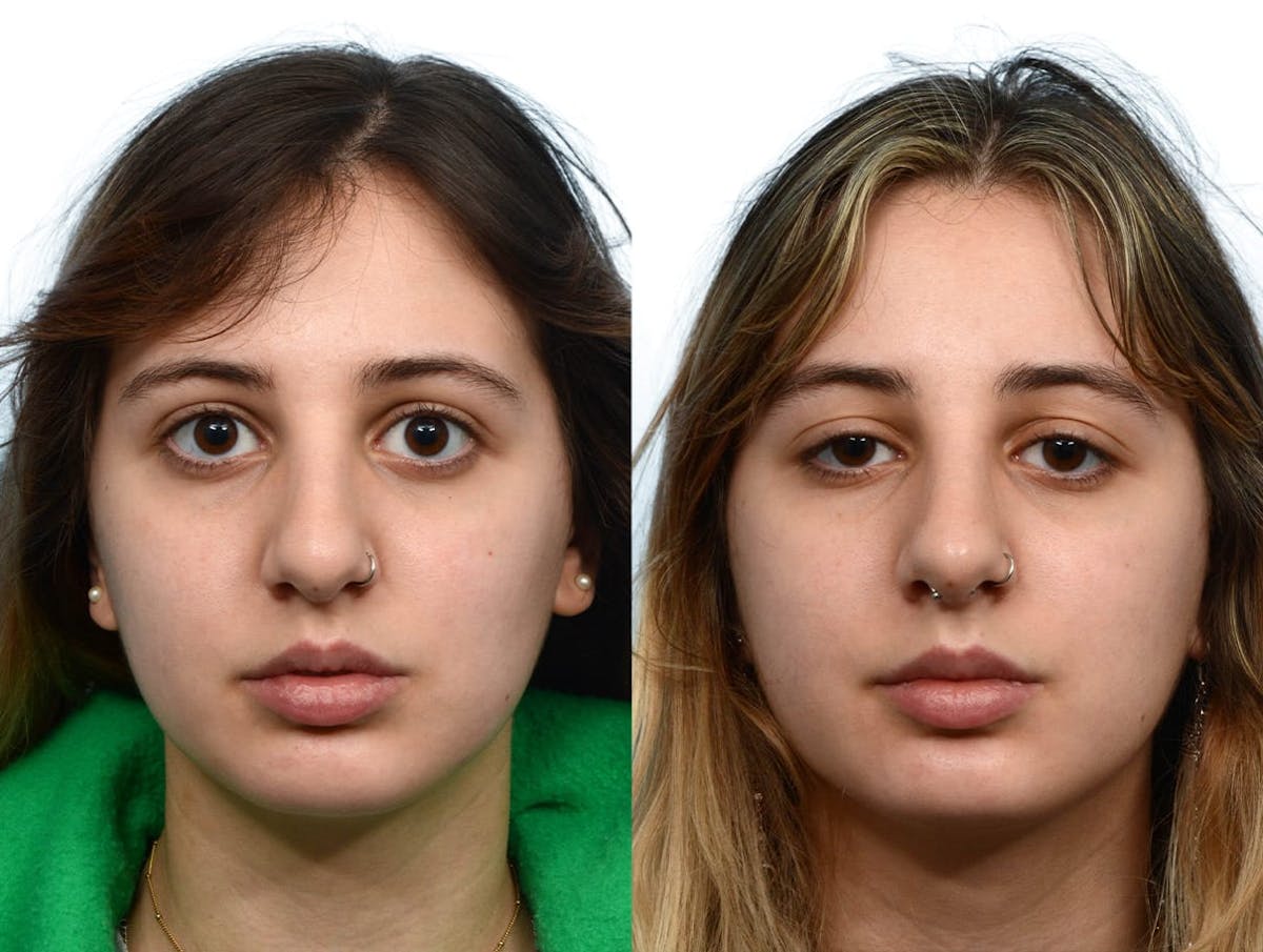 Non-Surgical Rhinoplasty Before & After Gallery - Patient 354630 - Image 2