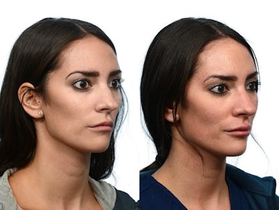 Non-Surgical Rhinoplasty Before & After Gallery - Patient 362119 - Image 1