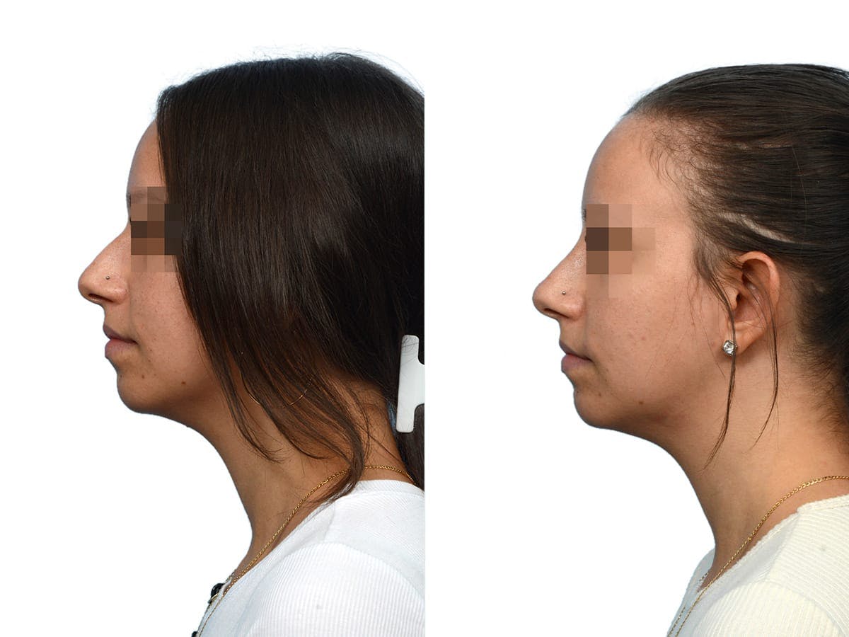 Non-Surgical Rhinoplasty Before & After Gallery - Patient 209609 - Image 1