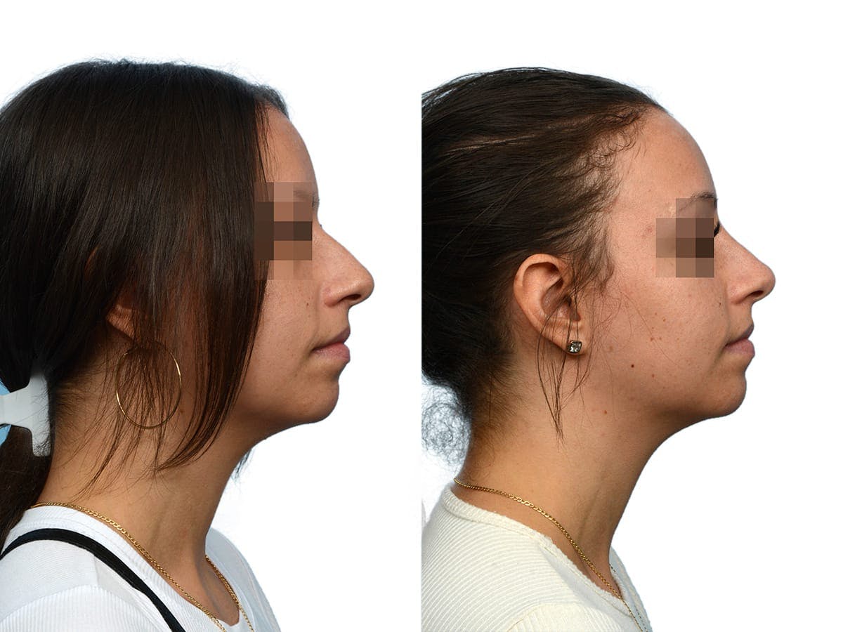 Non-Surgical Rhinoplasty Before & After Gallery - Patient 209609 - Image 2