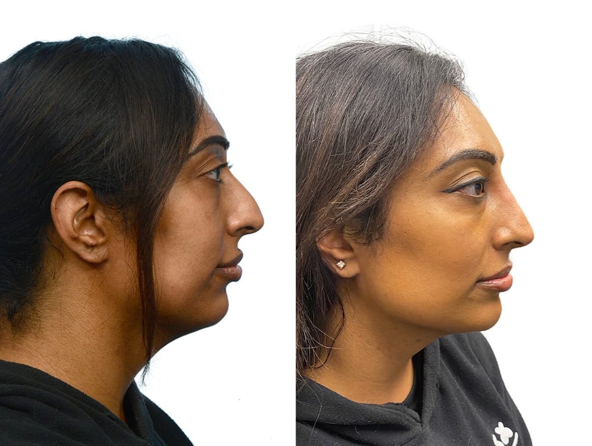 Non-Surgical Rhinoplasty Before & After Gallery - Patient 250786 - Image 1