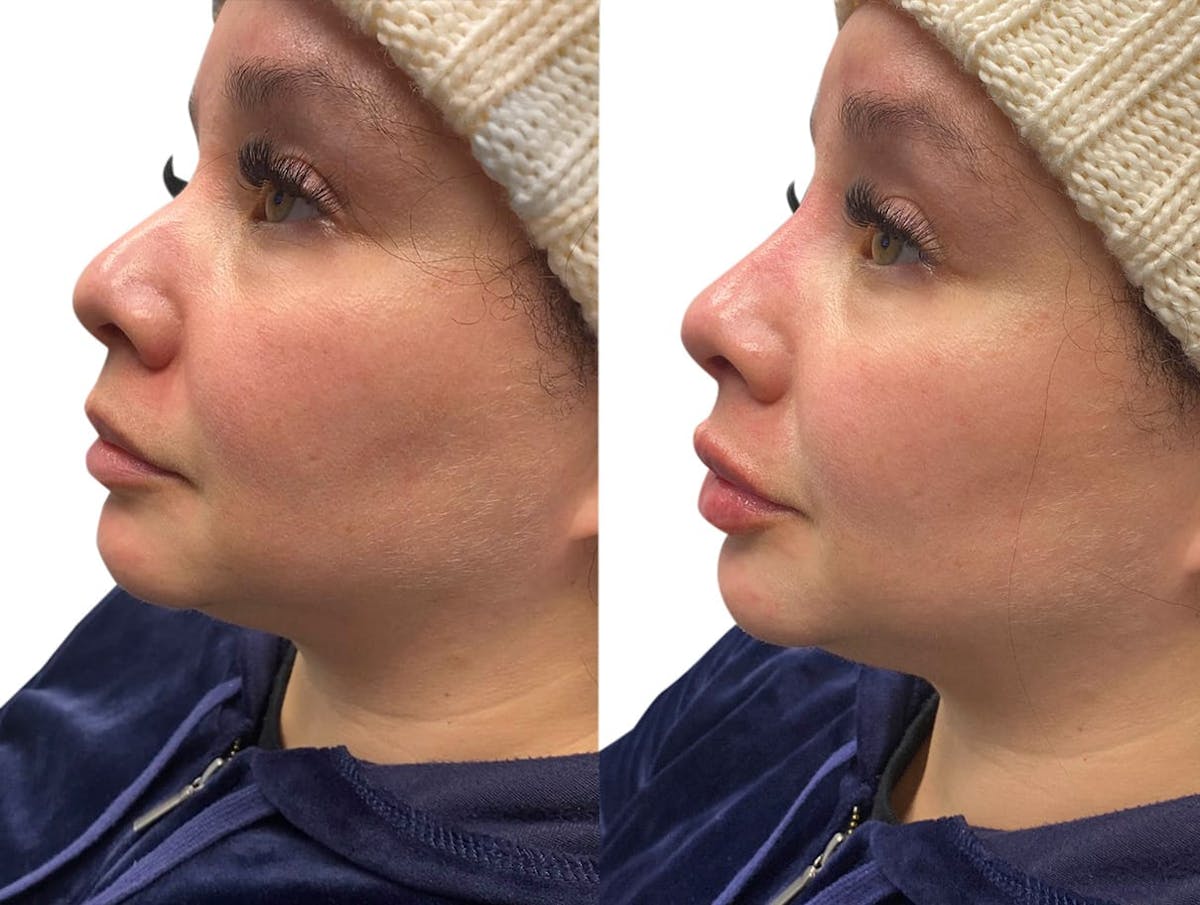 Non-Surgical Rhinoplasty Before & After Gallery - Patient 181434 - Image 1