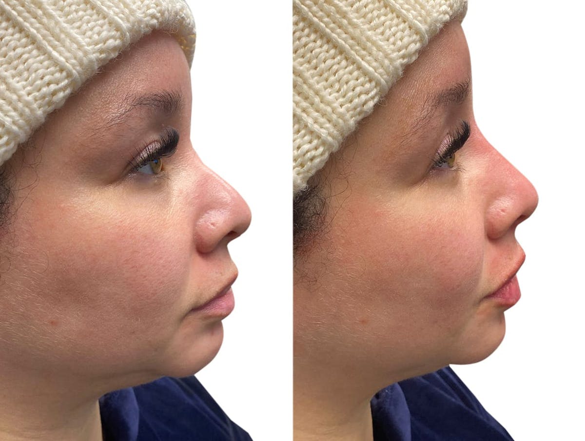 Non-Surgical Rhinoplasty Before & After Gallery - Patient 181434 - Image 2