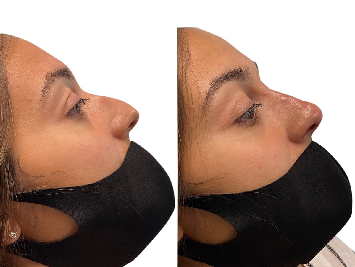 Non-Surgical Rhinoplasty Before & After Gallery - Patient 423015 - Image 2
