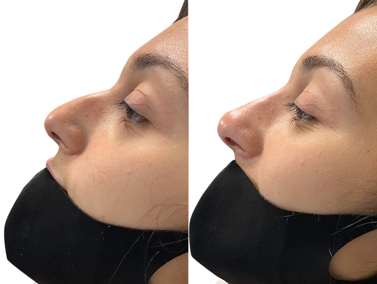 Non-Surgical Rhinoplasty Before & After Gallery - Patient 423015 - Image 1