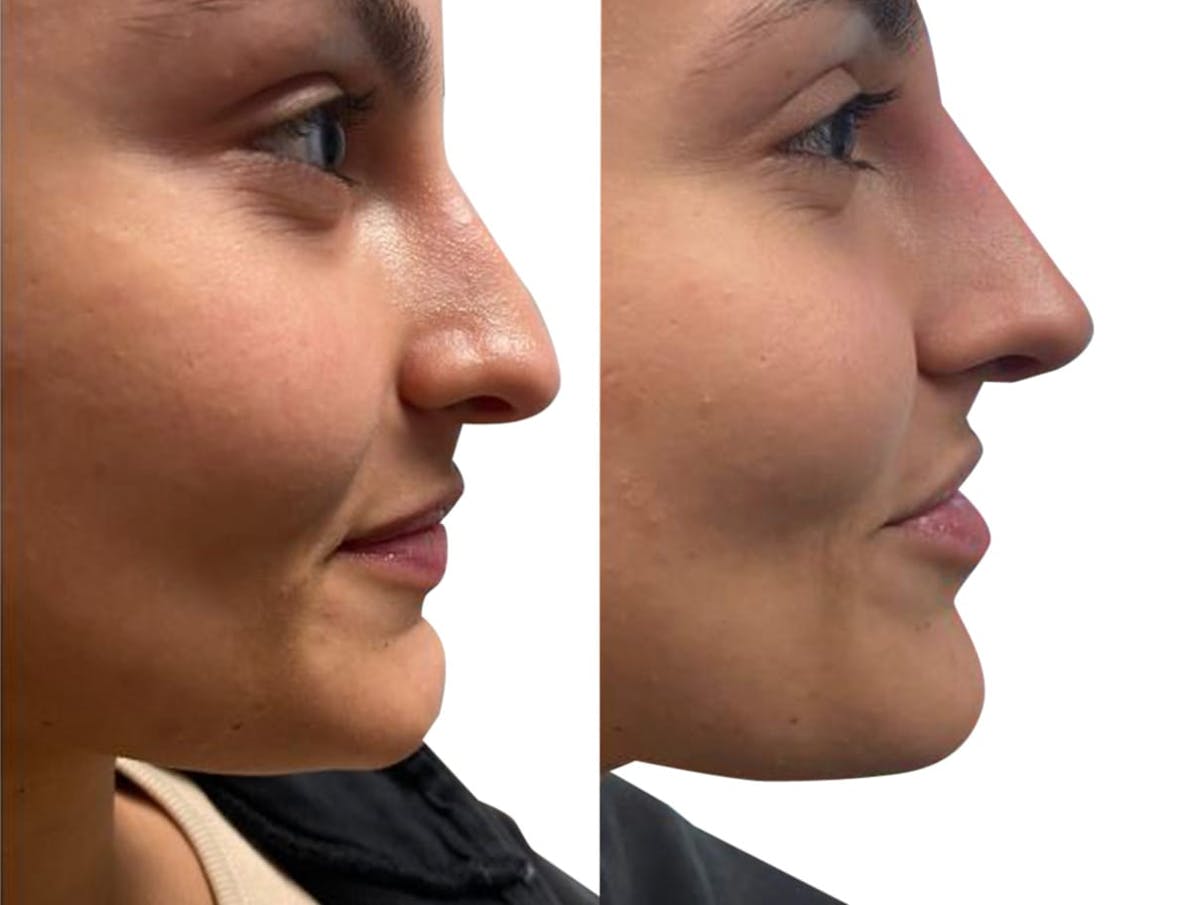 Non-Surgical Rhinoplasty Before & After Gallery - Patient 605707 - Image 2