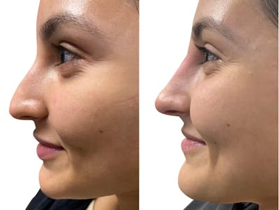 Non-Surgical Rhinoplasty Before & After Gallery - Patient 605707 - Image 1
