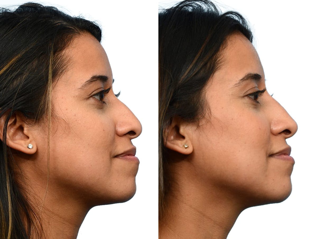 Non-Surgical Rhinoplasty Before & After Gallery - Patient 305330 - Image 2
