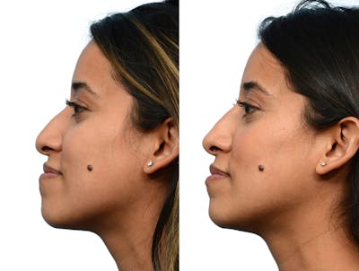 Non-Surgical Rhinoplasty Before & After Gallery - Patient 305330 - Image 1