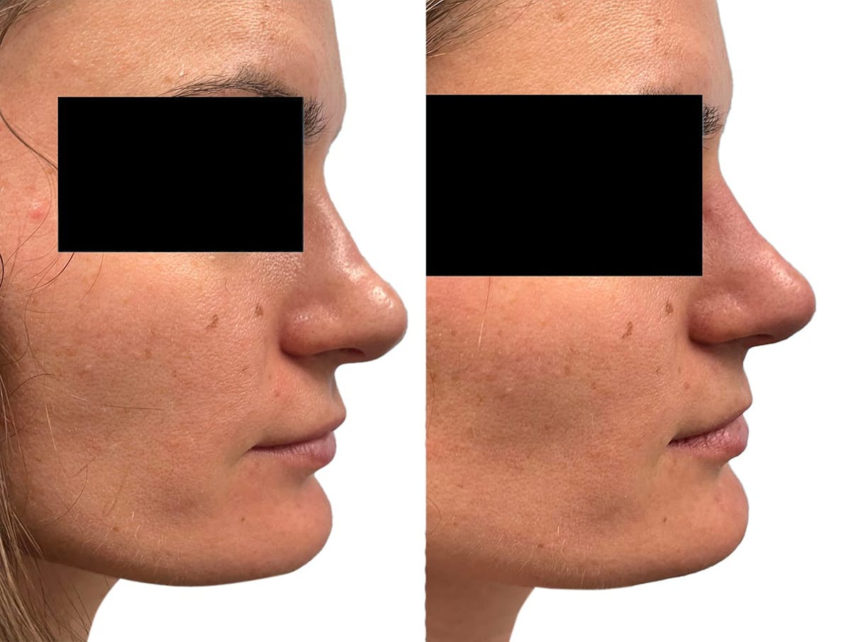 Non-Surgical Rhinoplasty Before & After Gallery - Patient 362959 - Image 1