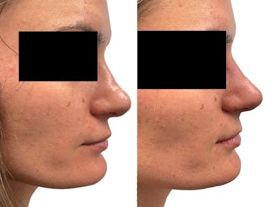 Non-Surgical Rhinoplasty Before & After Gallery - Patient 362959 - Image 1