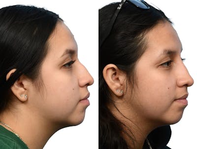 Non-Surgical Rhinoplasty Before & After Gallery - Patient 293595 - Image 1