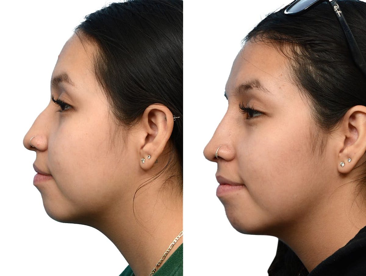 Non-Surgical Rhinoplasty Before & After Gallery - Patient 293595 - Image 2