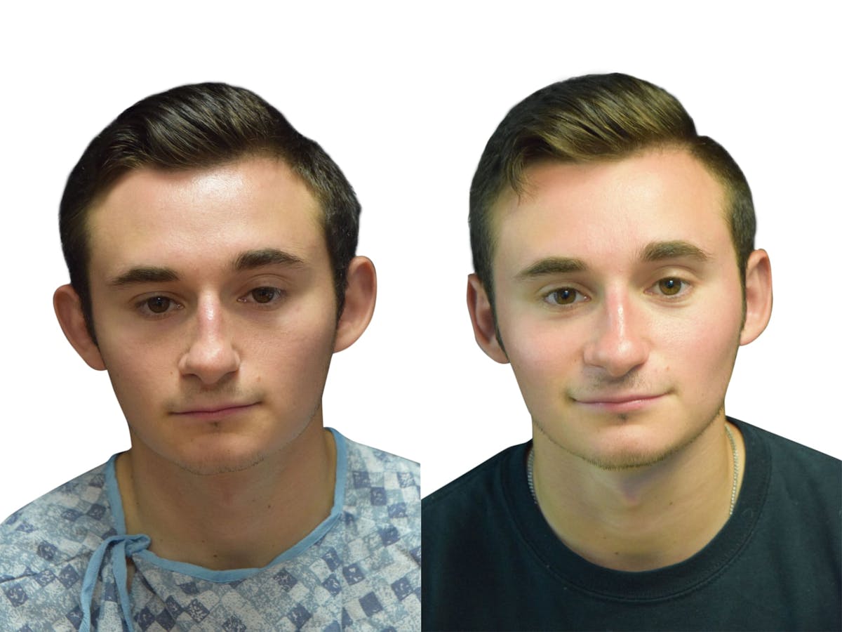 Otoplasty (Ear Surgery) Before & After Gallery - Patient 429117 - Image 1