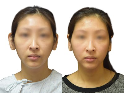 Otoplasty (Ear Surgery) Before & After Gallery - Patient 335889 - Image 1