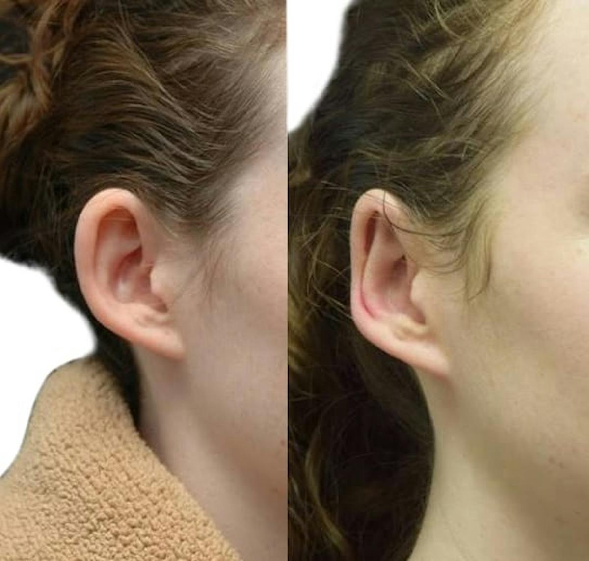 Otoplasty (Ear Surgery) Before & After Gallery - Patient 407716 - Image 2
