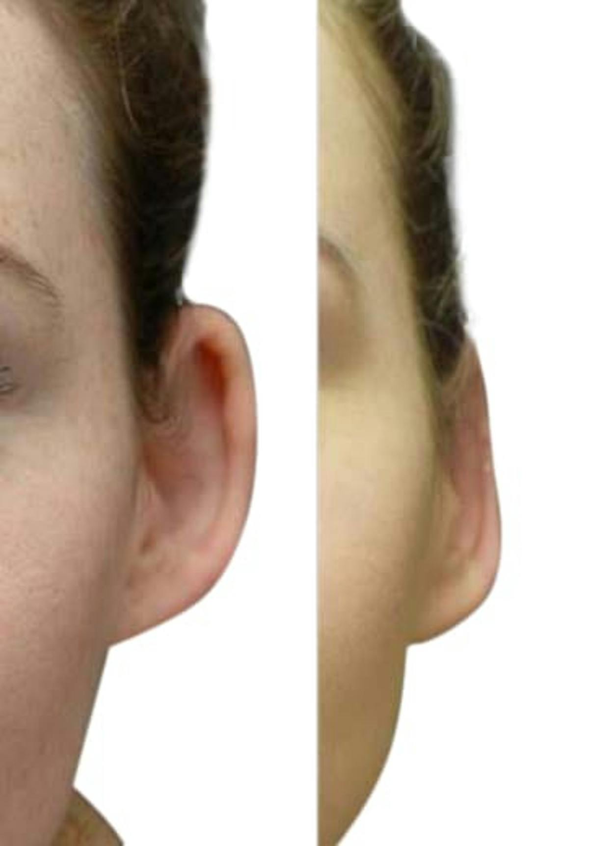 Otoplasty (Ear Surgery) Before & After Gallery - Patient 407716 - Image 3
