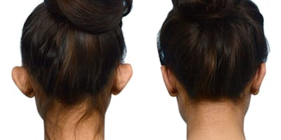Otoplasty (Ear Surgery) Before & After Gallery - Patient 350123 - Image 1