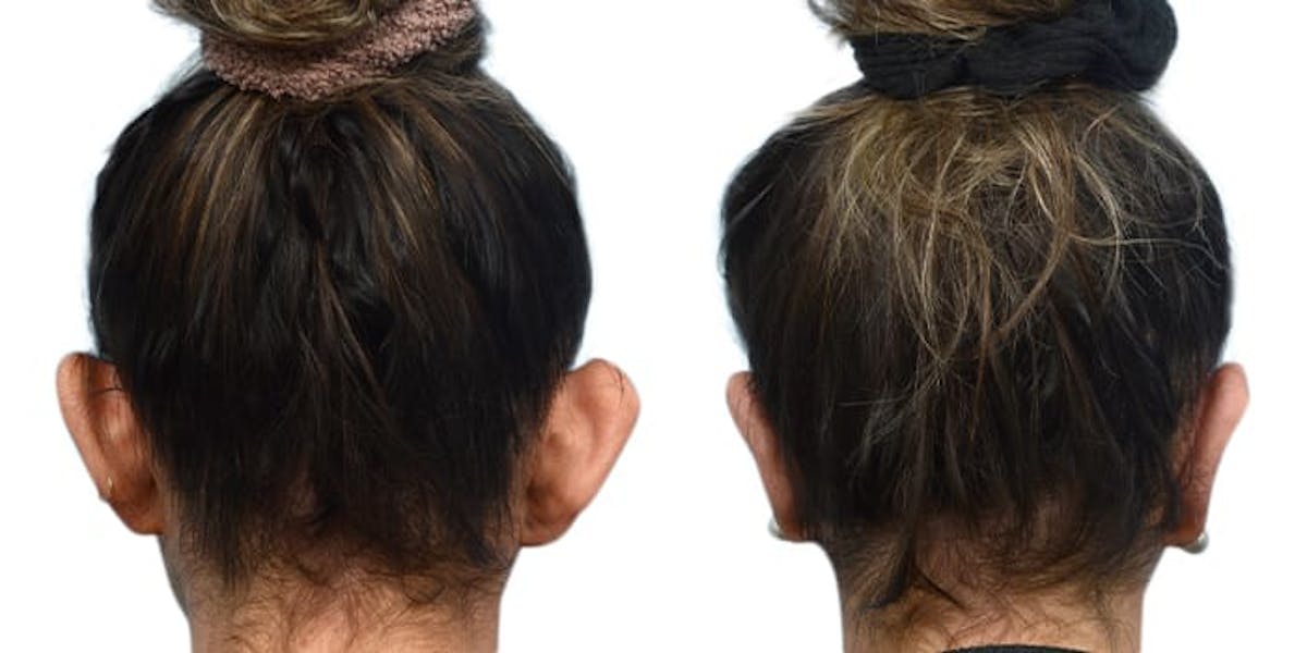Otoplasty (Ear Surgery) Before & After Gallery - Patient 272676 - Image 2