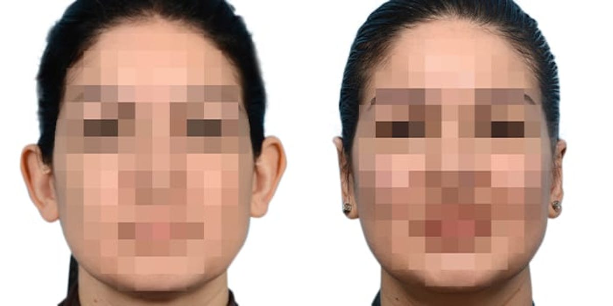 Otoplasty (Ear Surgery) Before & After Gallery - Patient 995776 - Image 1