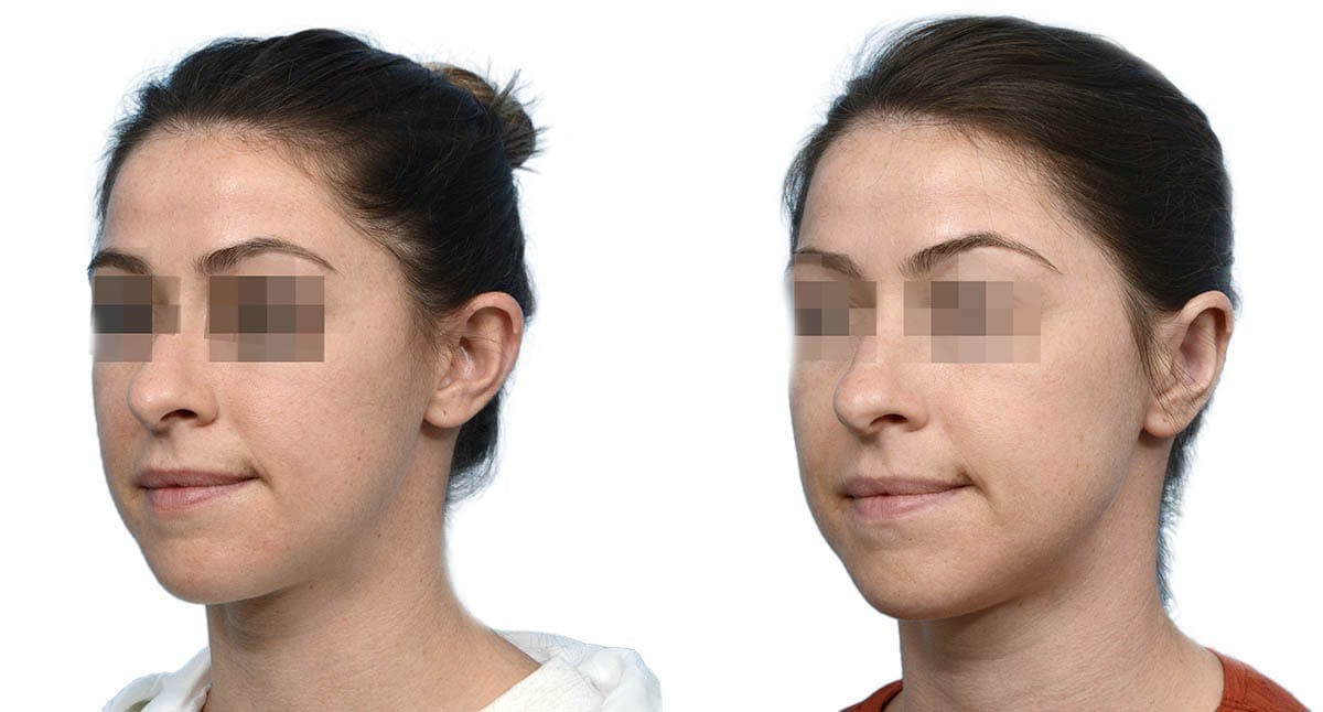 Otoplasty (Ear Surgery) Before & After Gallery - Patient 372341 - Image 2