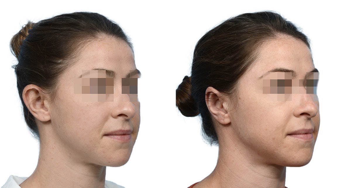 Otoplasty (Ear Surgery) Before & After Gallery - Patient 372341 - Image 3